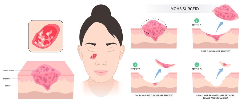 How Mohs Surgery Works · Conway Medical Center