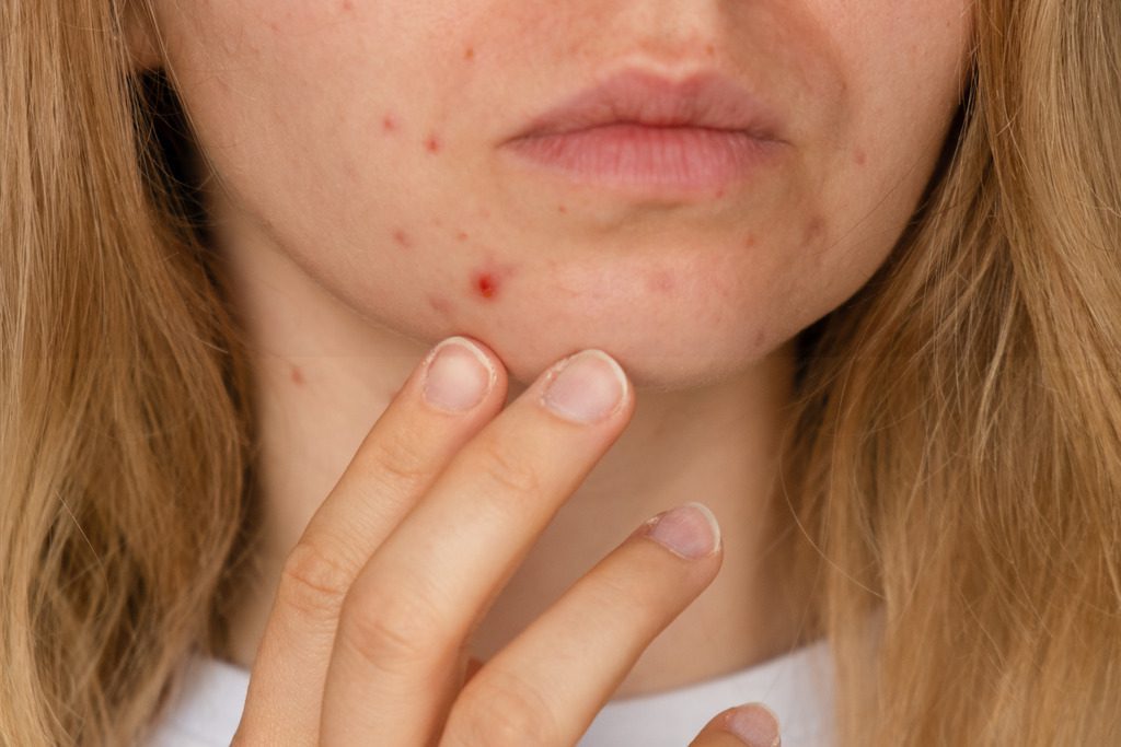 The Right Dermatology Acne Treatment Can Change Your Life