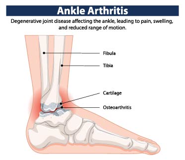 Ankle Arthritis_825935690 [Converted]-01